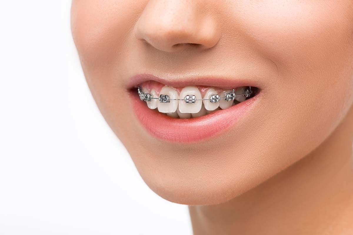 How much do braces cost in London : ODL Dental Clinic - Orthodontics -  Affordable Braces London